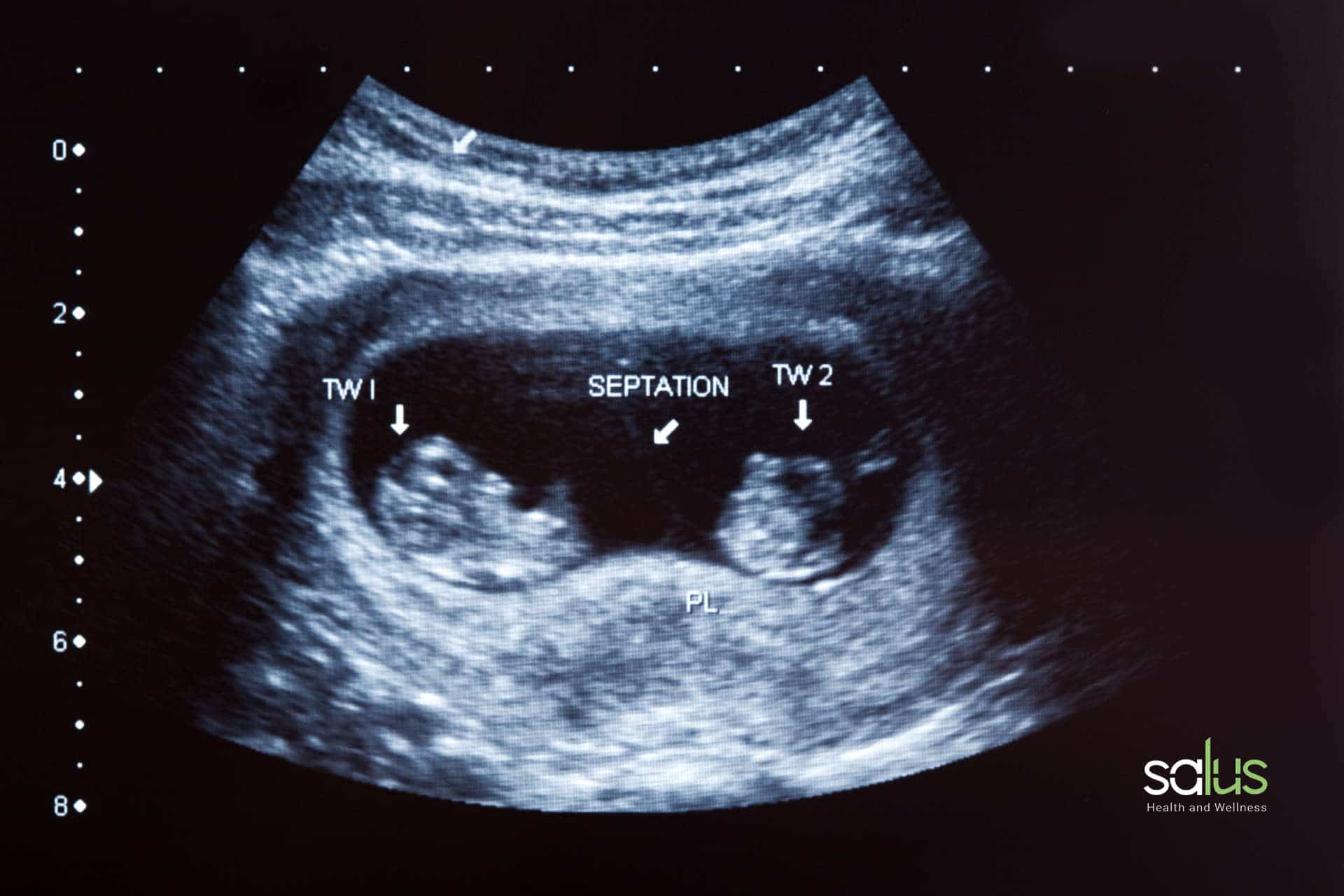 Salus blog - sintomi gravidanza gemellare