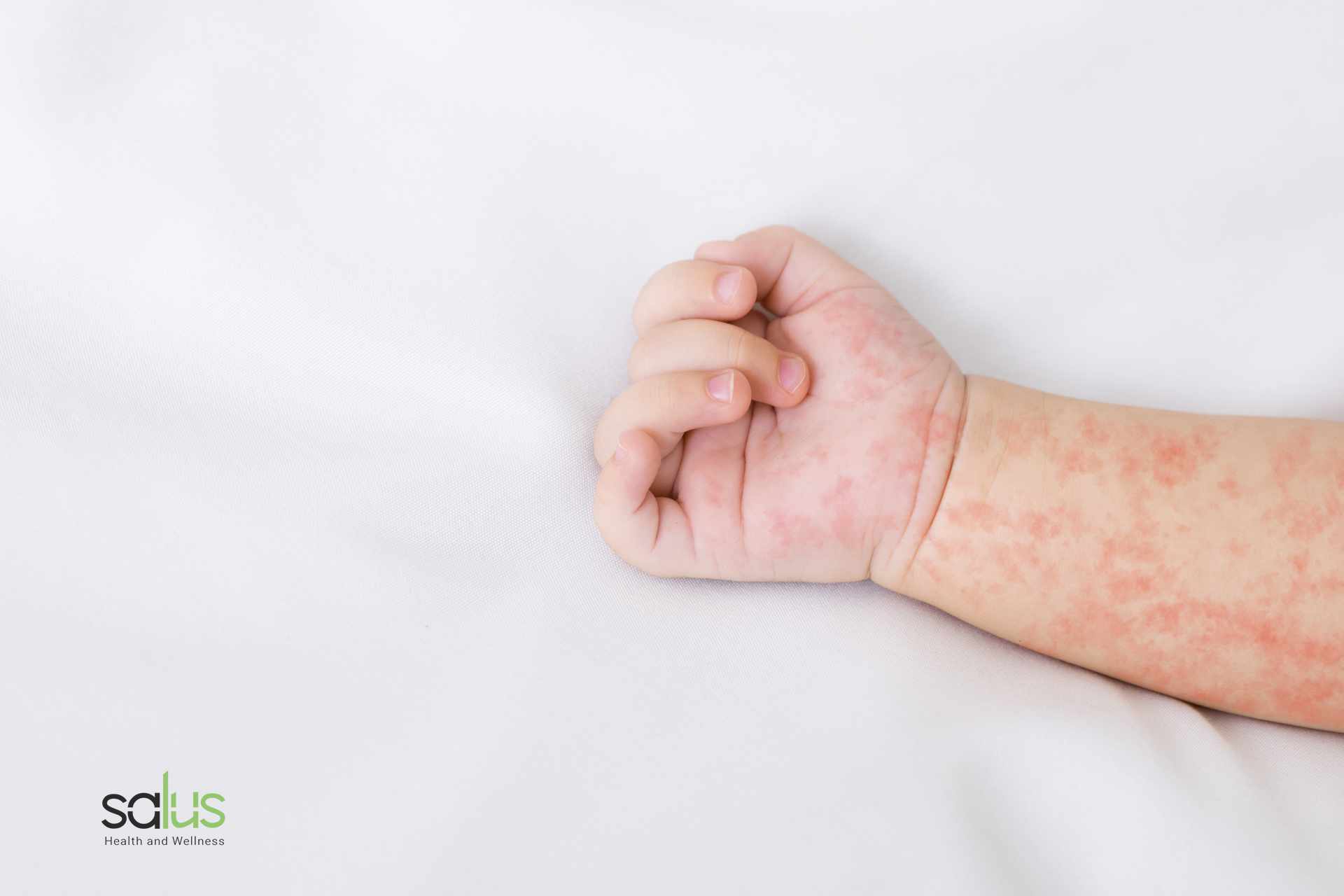 Salus Blog - dermatite sudore bambini